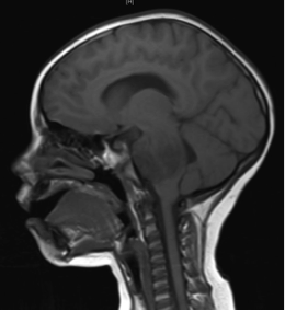 Coupe sagittale de tête et cou par IRM